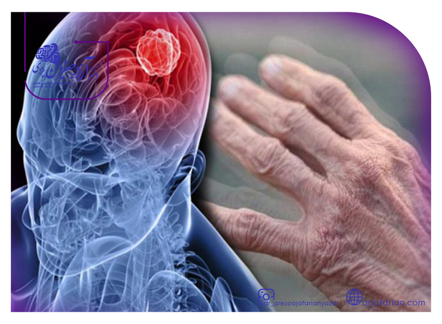 راهکار های تشخیص بیماری پارکینسون