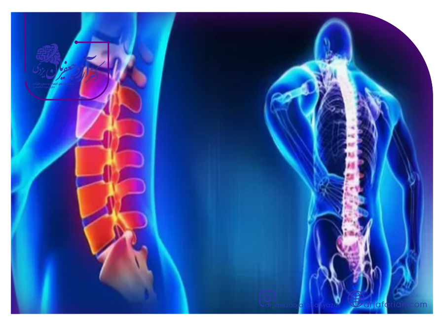 انحنای ستون فقرات