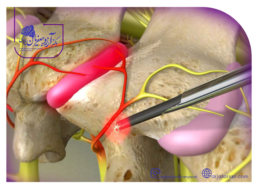 انواع بلاک عصبی