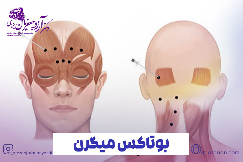 بوتاکس میگرن