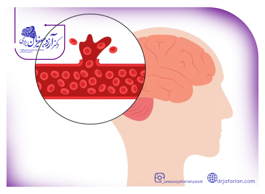 انواع سکته مغزی هموراژیک