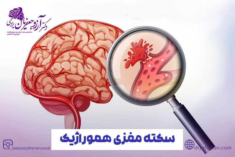 سکته مغزی هموراژیک