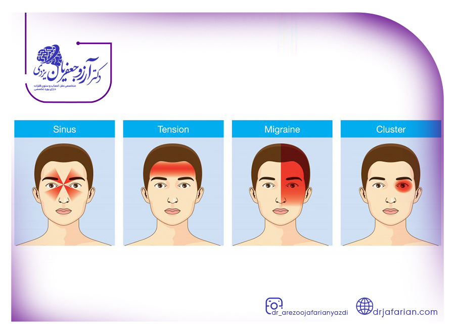انواع سردرد