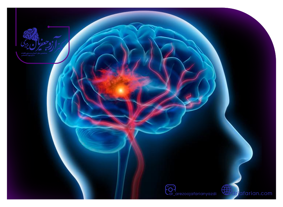 درمان سکته مغزی هموراژیک
