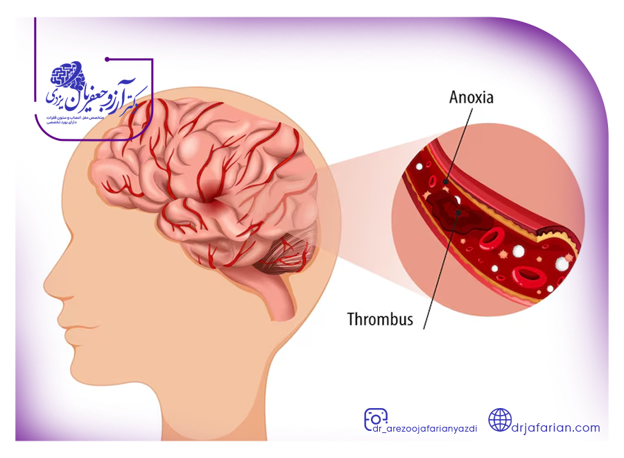 درمان سکته مغزی چگونه است؟