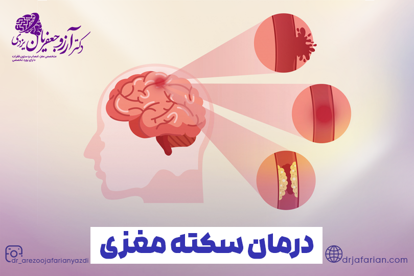 درمان سکته مغزی